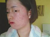 美丽陷阱 蕾特恩19元祛痘体验 让数十名女孩落入“美容贷”